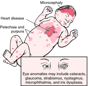 Rubella can cause serious defects in a developing fetus
